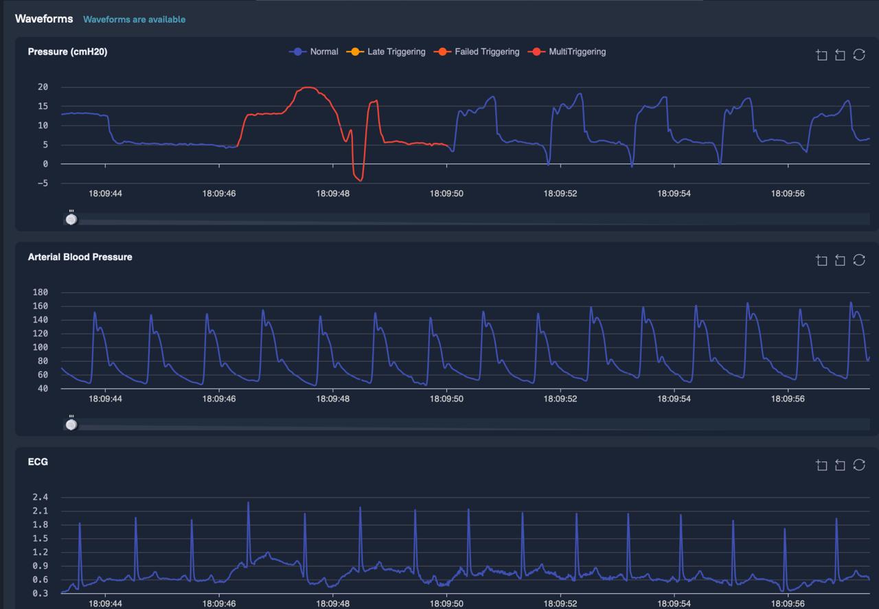 Why High-Frequency Data Monitoring Matters in the ICU