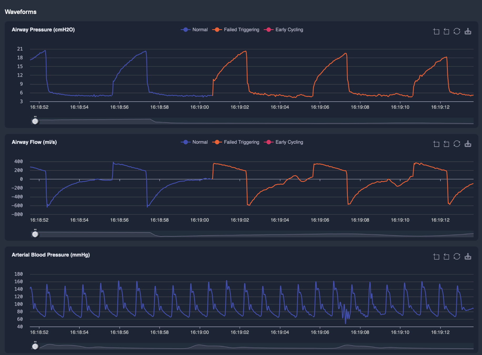 Transpulmonary pressure, patient effort and work of breathing analysis